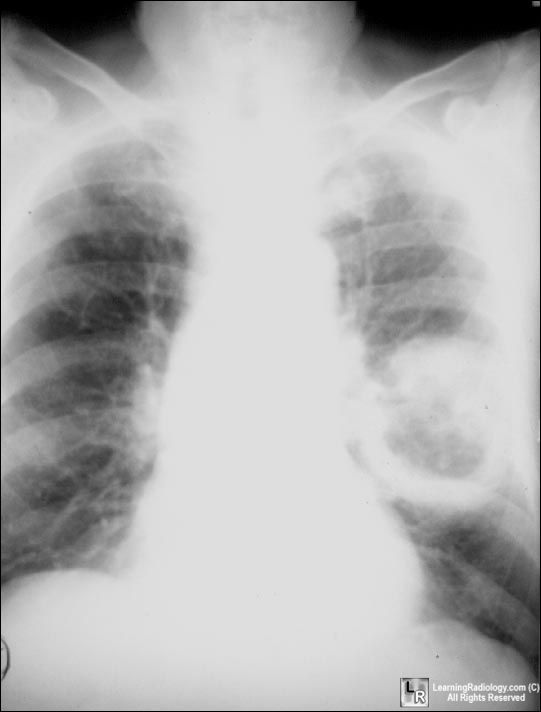 Bronchogenic carcinoma